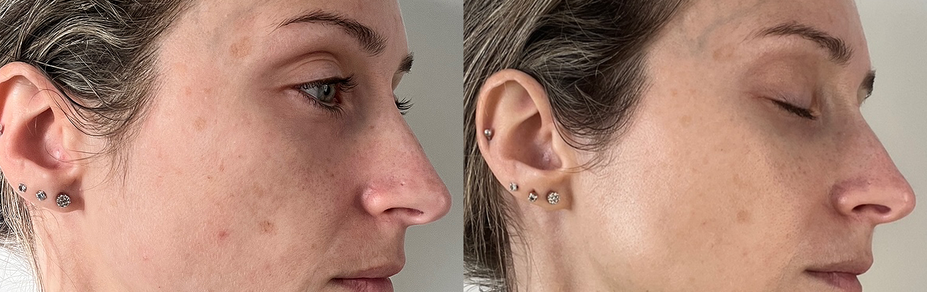 SKIN GLOW JOURNEY: The Transformation to Radiant Skin With LumaLux Face+