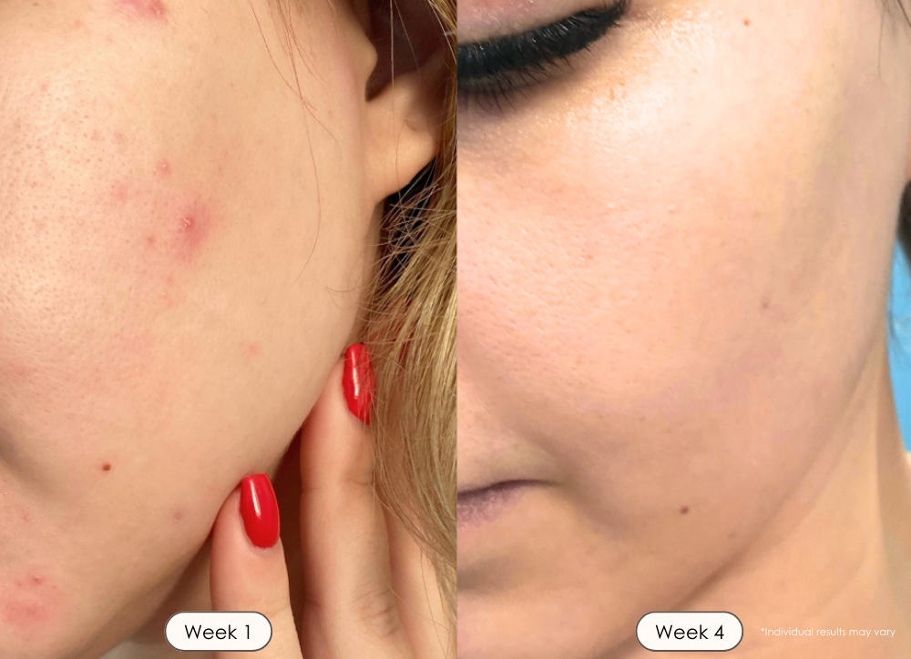 LightAura Plus LED face neck mask light therapy before and after results showing reduced acne after 30 days
