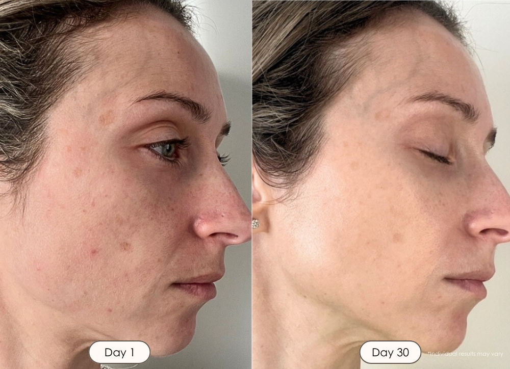 LightAura Plus LED face neck mask light therapy before and after results showing faded acne scars and reduced redness after 30 days