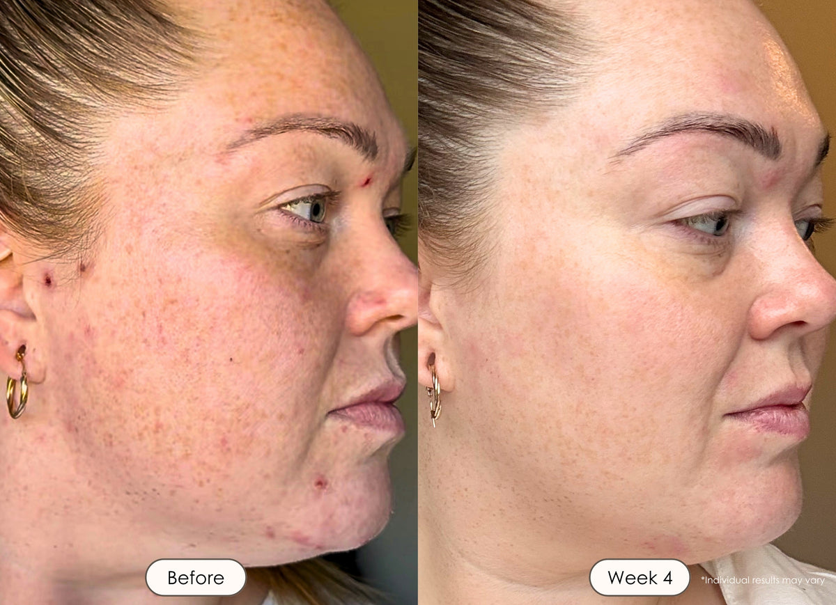 Comparison image showing clearer-looking skin and reduced appearance of blemishes.